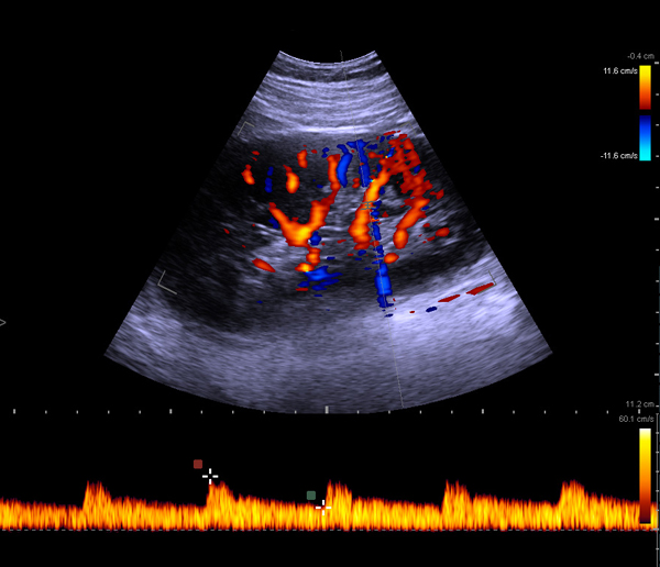 kidney ultrasound