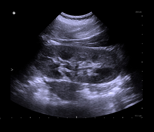 kidney stones ultrasound