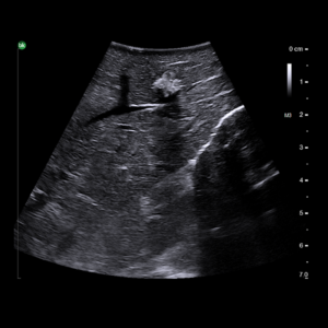 Intraoperative Ultrasound for General Surgery and HPB | BK Medical