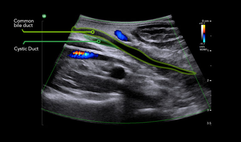 Intraoperative Ultrasound For General Surgery And HPB | BK Medical