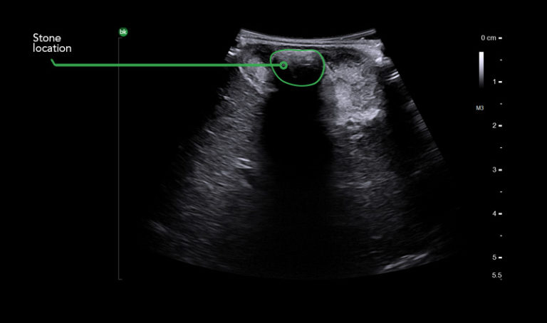 Intraoperative Ultrasound For General Surgery And HPB | BK Medical